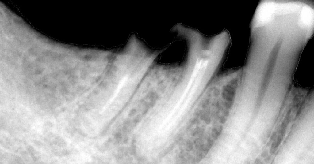 Toothache Root Canal